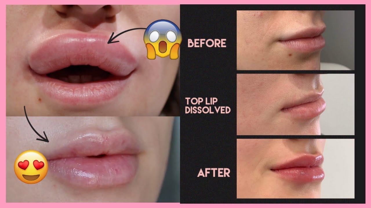 1 Week Lip Filler Swelling Stages