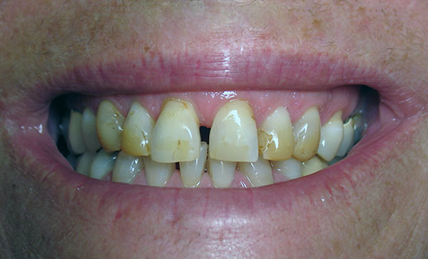 Are Coffee Stains on Teeth Permanent