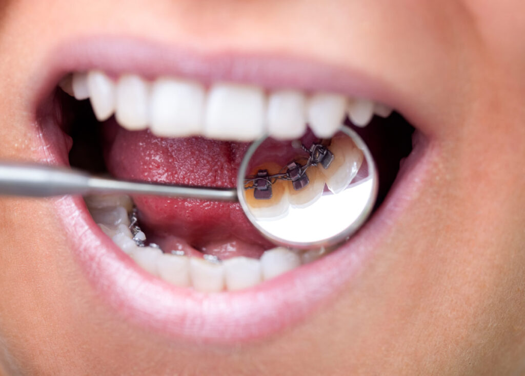Can I Get Braces Behind my Teeth