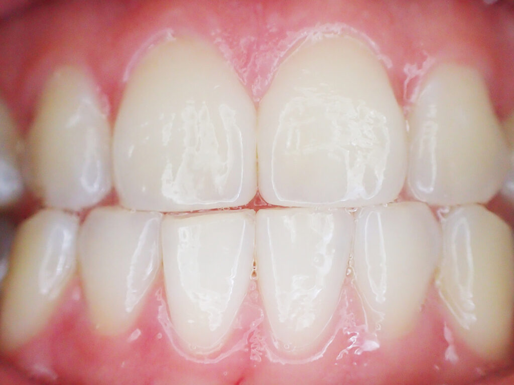 Can You Fix Craze Lines in Teeth