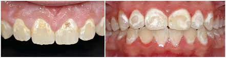 Can You Reverse Decalcification of Teeth