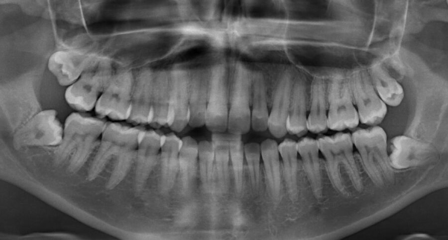Can You See Wisdom Teeth On X-ray