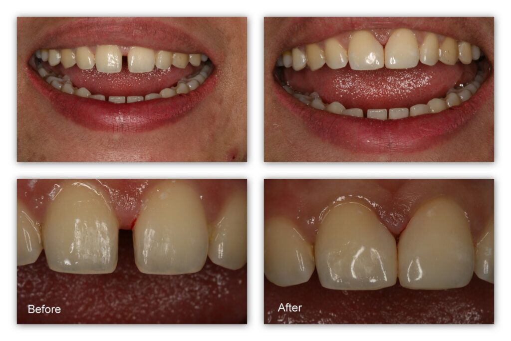 Can the gap between teeth be filled