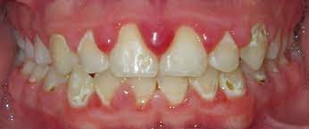 Decalcification Teeth