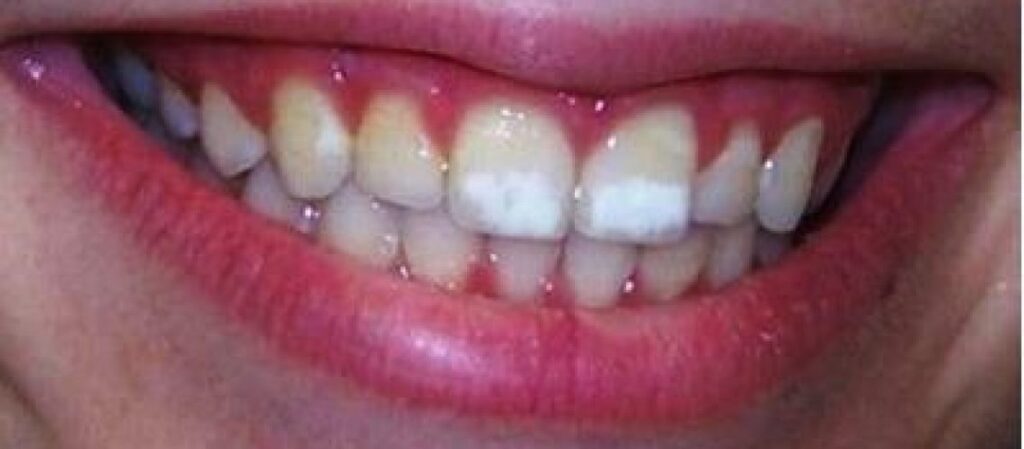 Do Calcium Spots on Teeth go Away