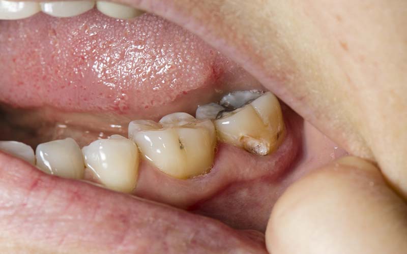 Do cavities between teeth need to be filled