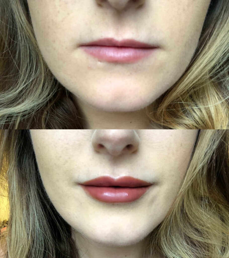 Does 1 Ml of Lip Filler Make a Difference