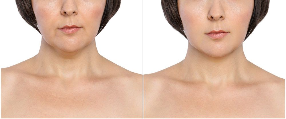 Does Neck fat Come Back After Liposuction