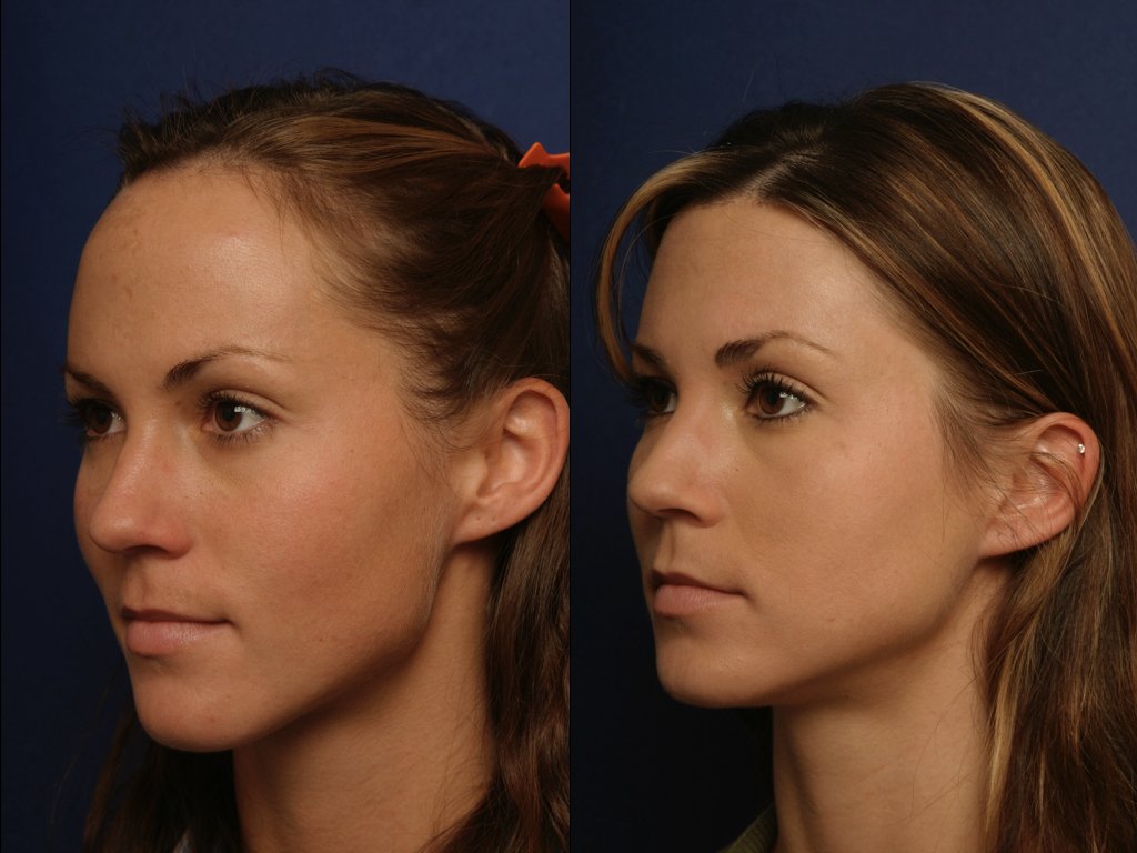Forehead-Reduction-Surgery