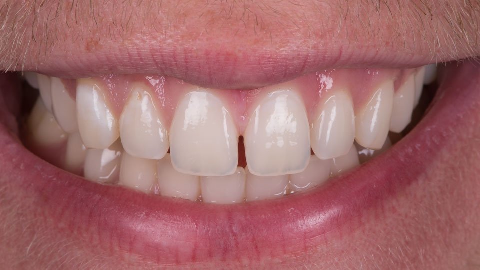 How Can I Permanently Fill a Gap in My Teeth