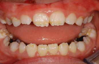 How Do You Fix Hypoplastic Teeth