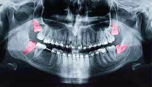 How Long Does it Take to Remove 4 Wisdom Teeth