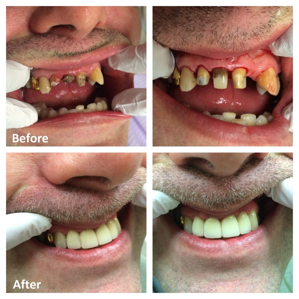 Front Teeth Crowns Before and After