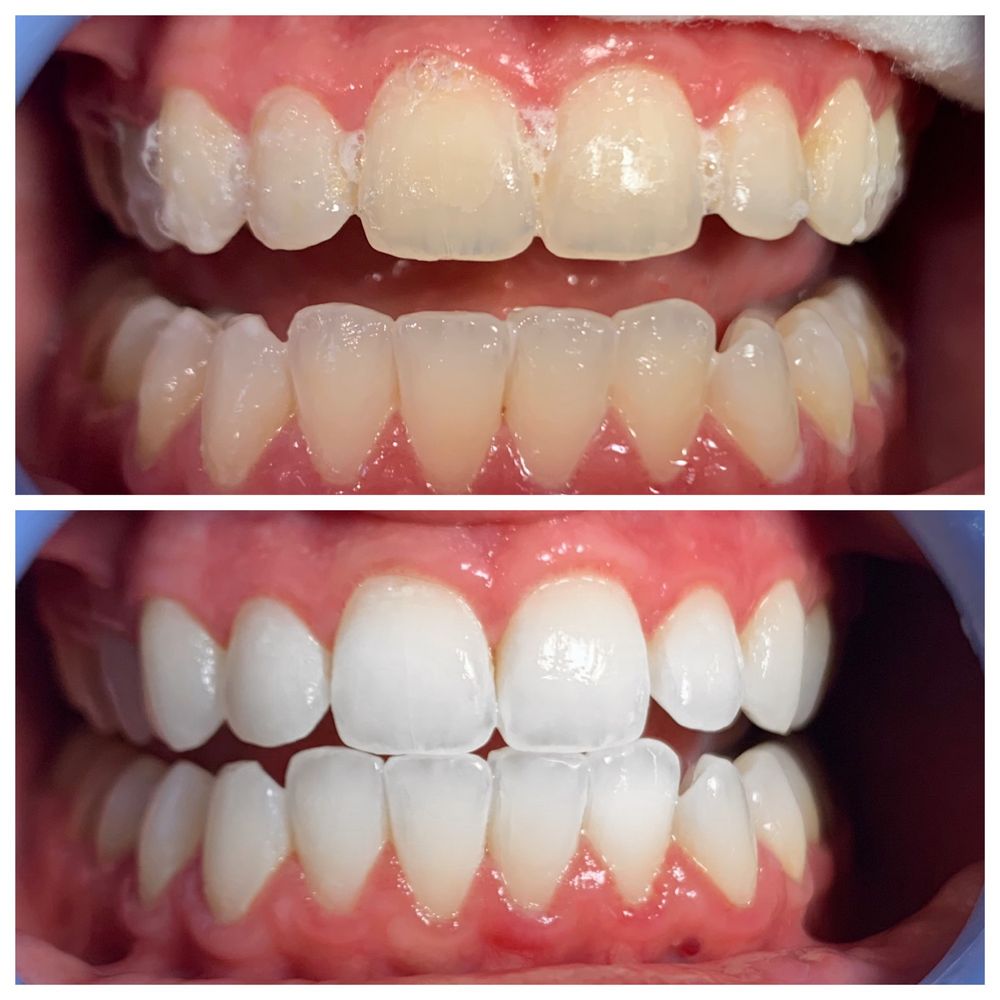 How Often Can You do DaVinci Teeth Whitening