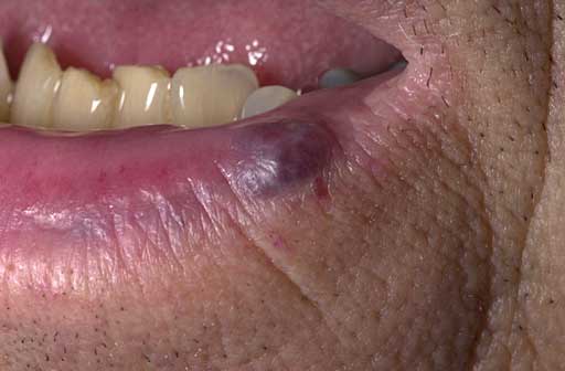 How do You Treat Venous Lake on Lips