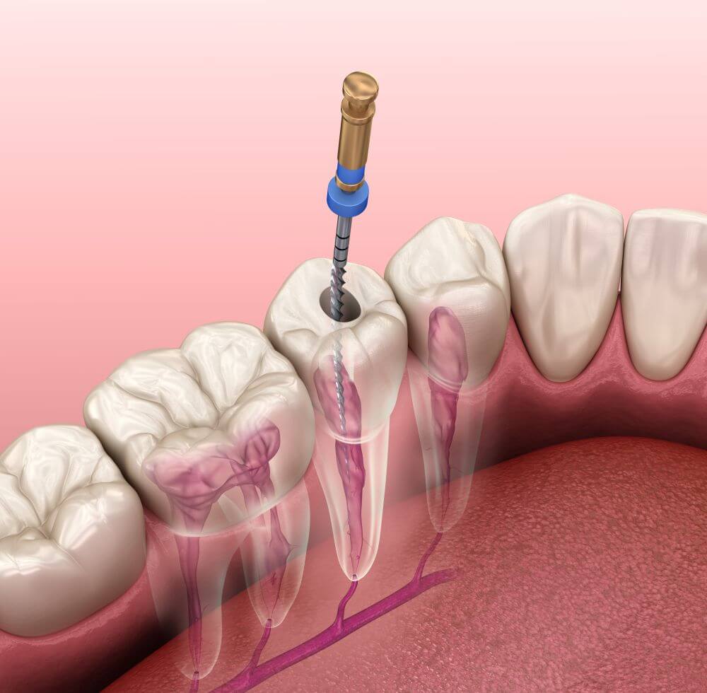 How successful are root canals on front teeth