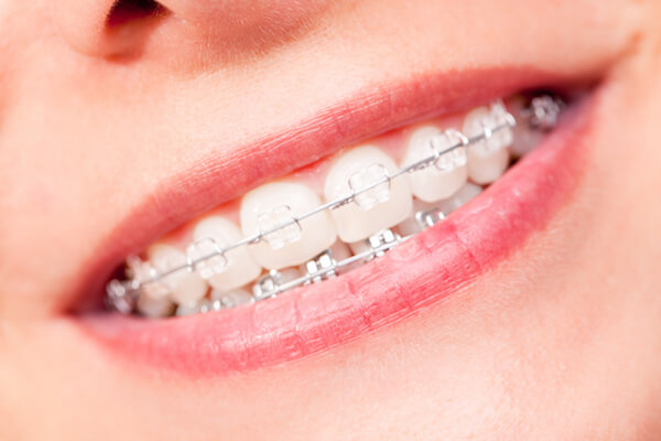 How to Whiten Teeth With Braces