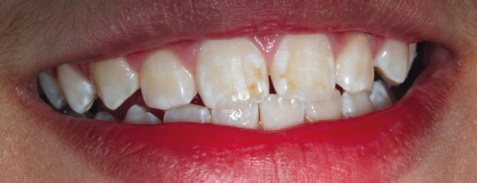 Hypoplasia Teeth