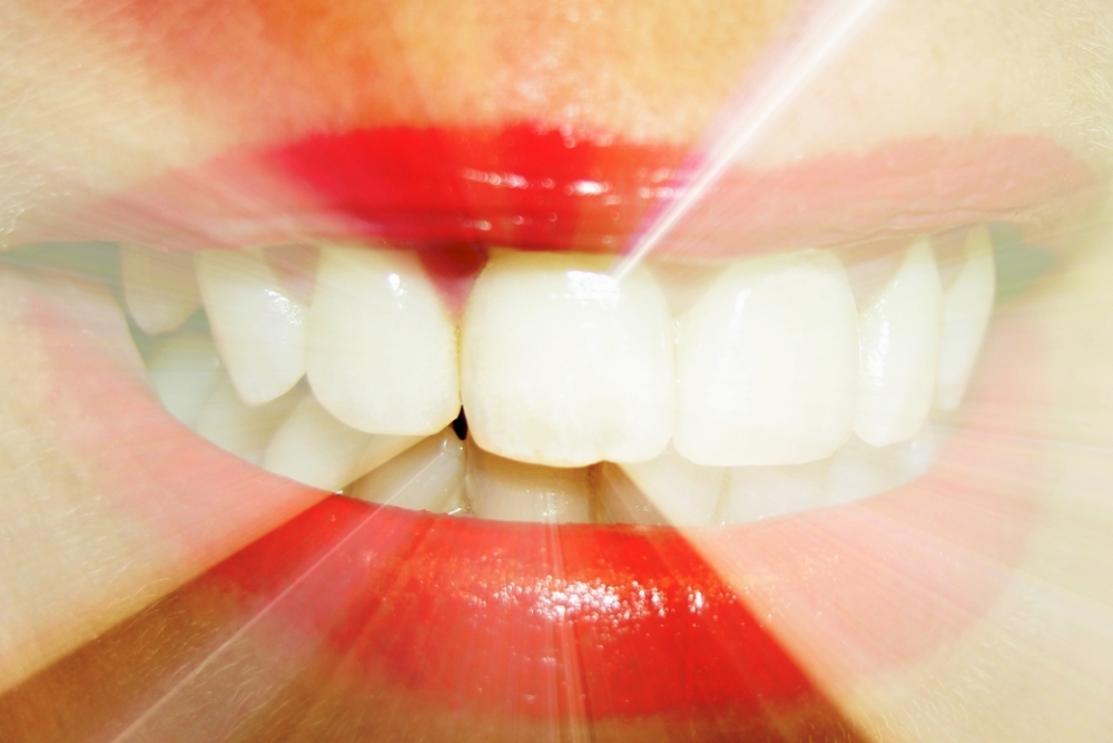 Is Snow Teeth Whitening Good for You