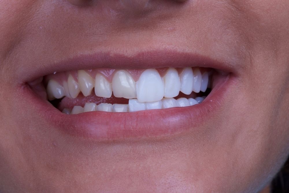 Is Teeth Bonding The Same as Veneers