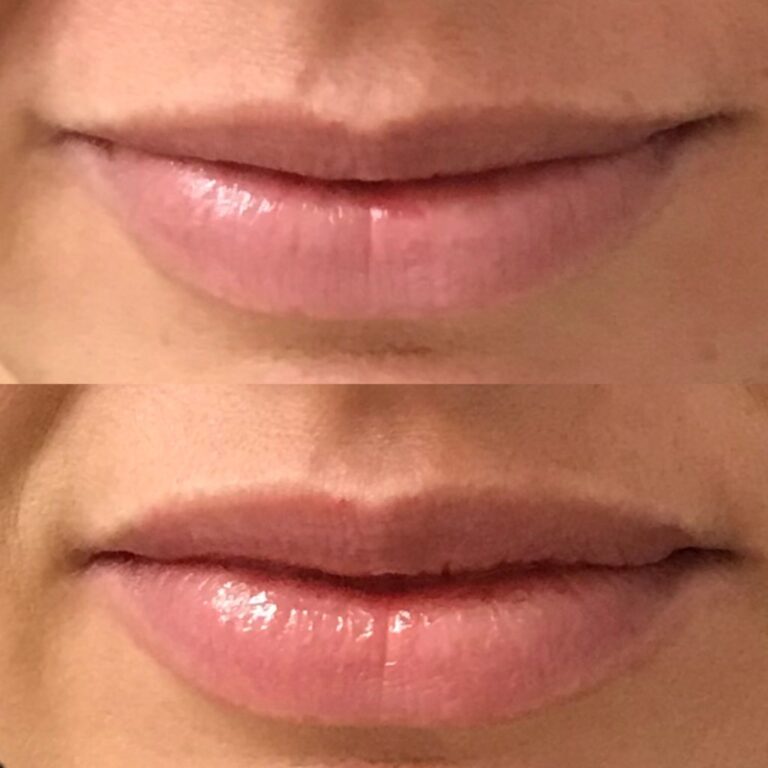 How Many Units of Botox For Lip Flip