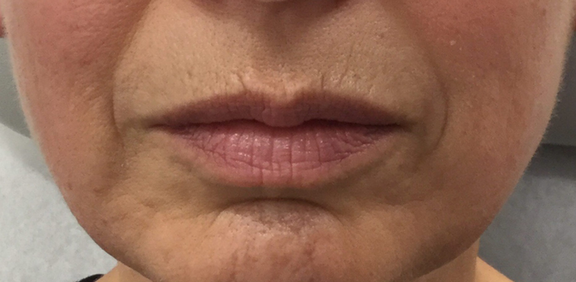 Juvederm Lips Before and After