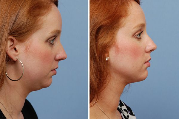 Neck Lipo Before and After