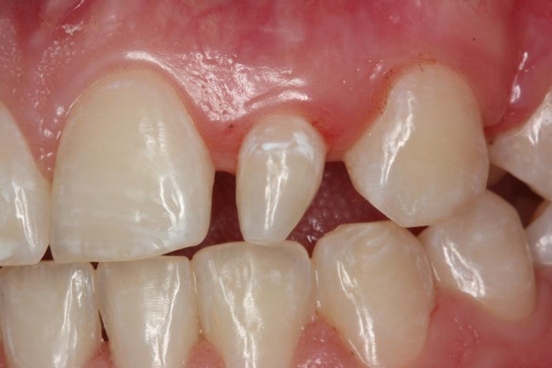 Peg Lateral Teeth