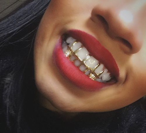 Permanent Gold Teeth