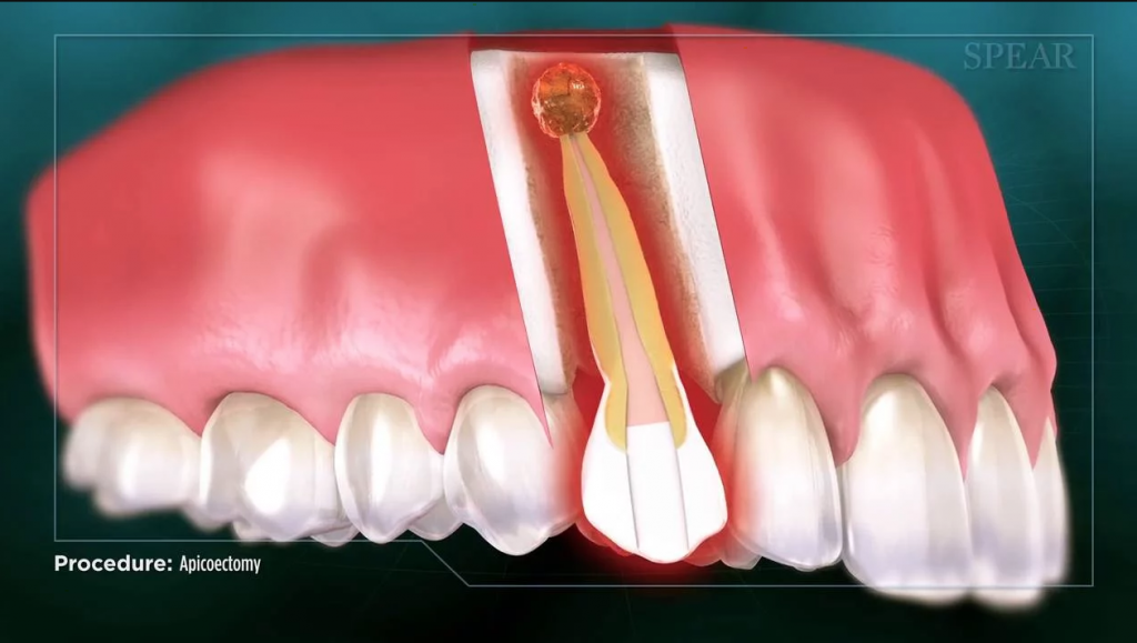 Root Canal on Front Teeth