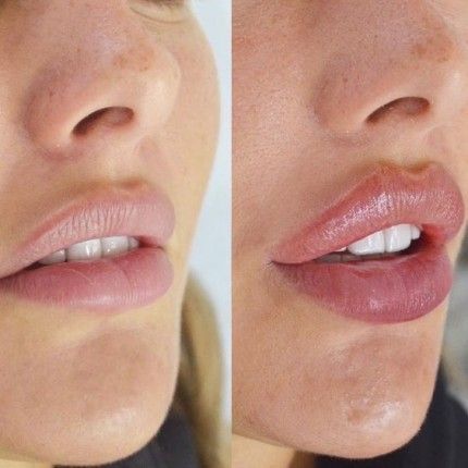Russian Lip Filler Technique