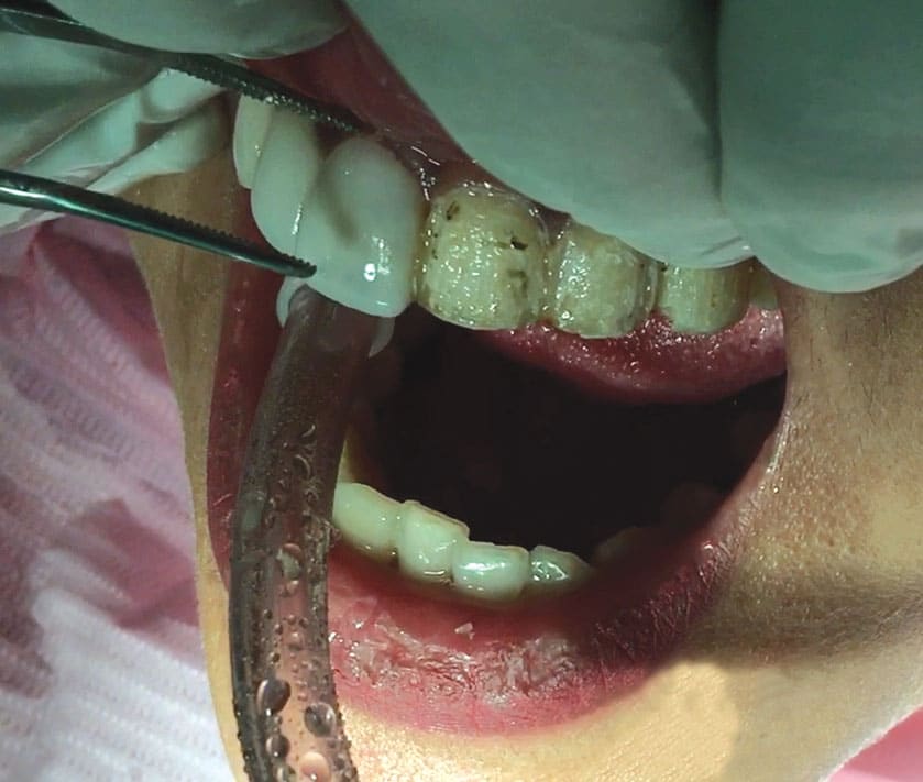Teeth After Veneers Removed