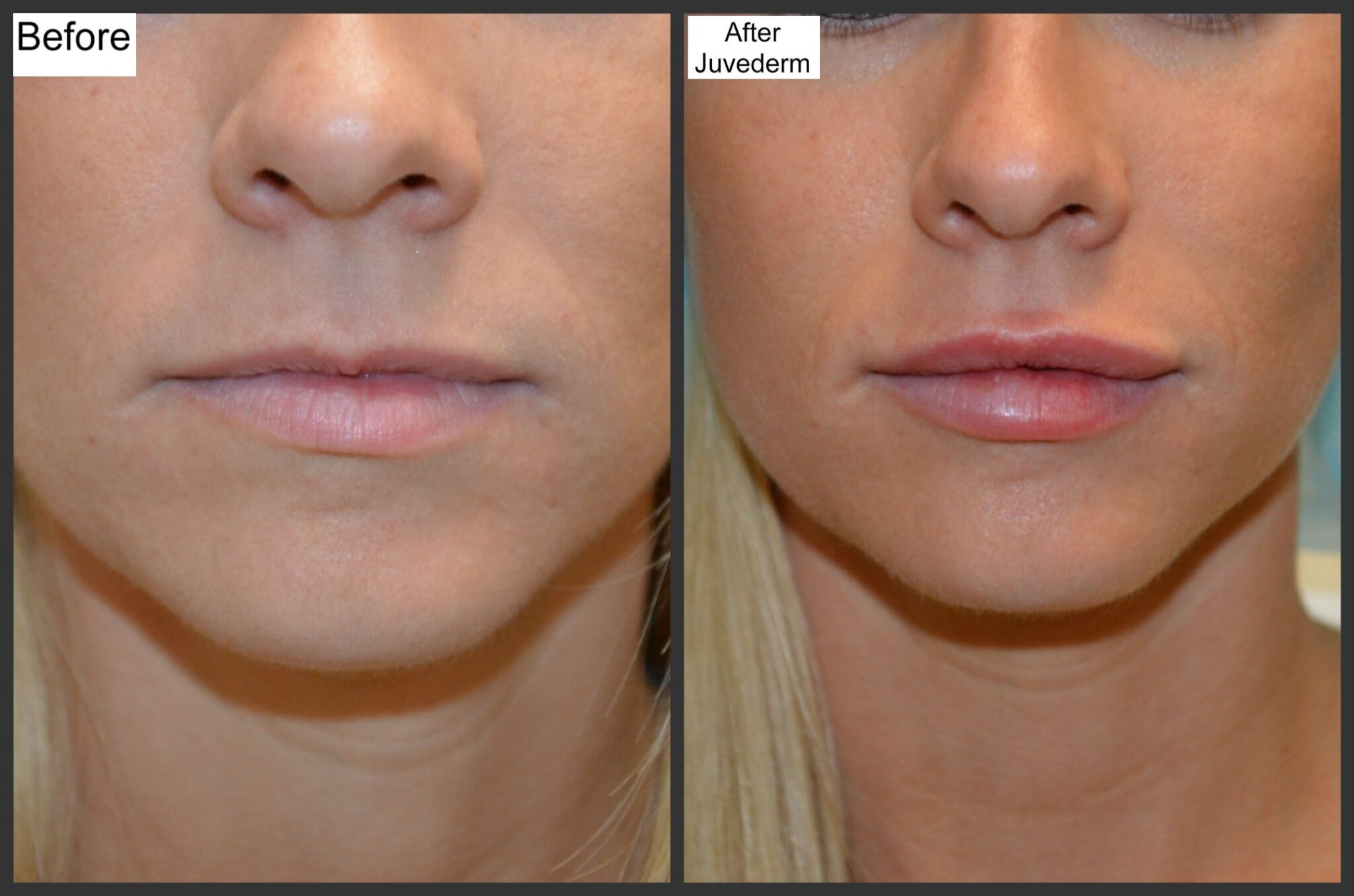 lip-fillers-before-and-after-thin-lips