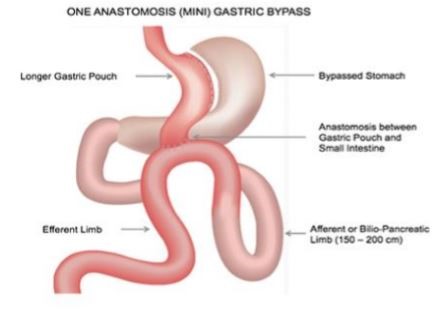 At What Weight Can You Get Gastric Bypass