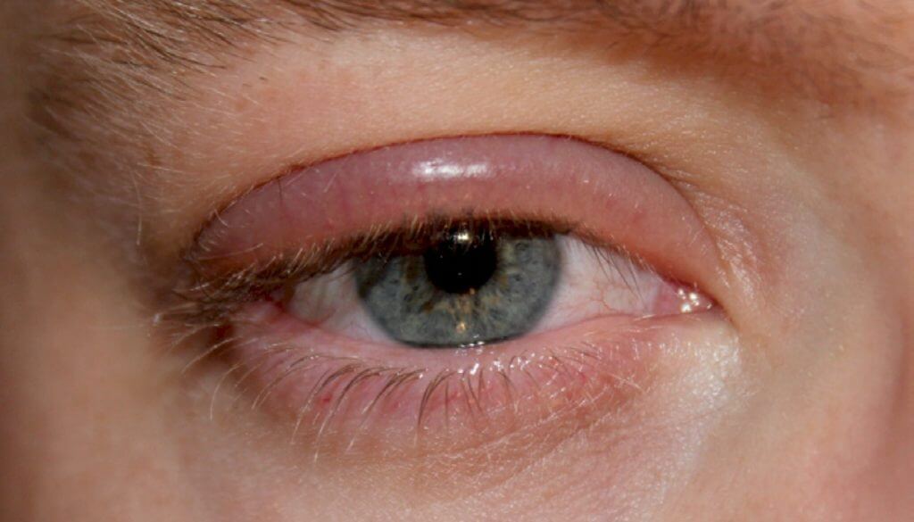 Blepharitis From Eyelash Extensions