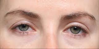 Can Botched Eyelid Surgery be Corrected