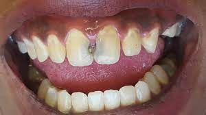 Can Cavities Be Filled on Front Teeth