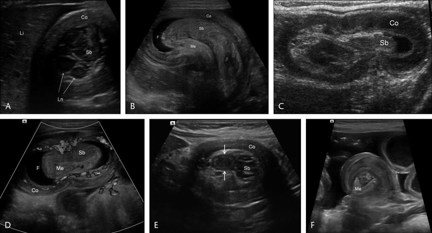 Can Intussusception Be Seen On Ultrasound