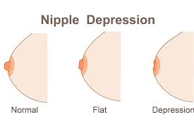 Can Inverted Nipples Be Corrected Without Surgery