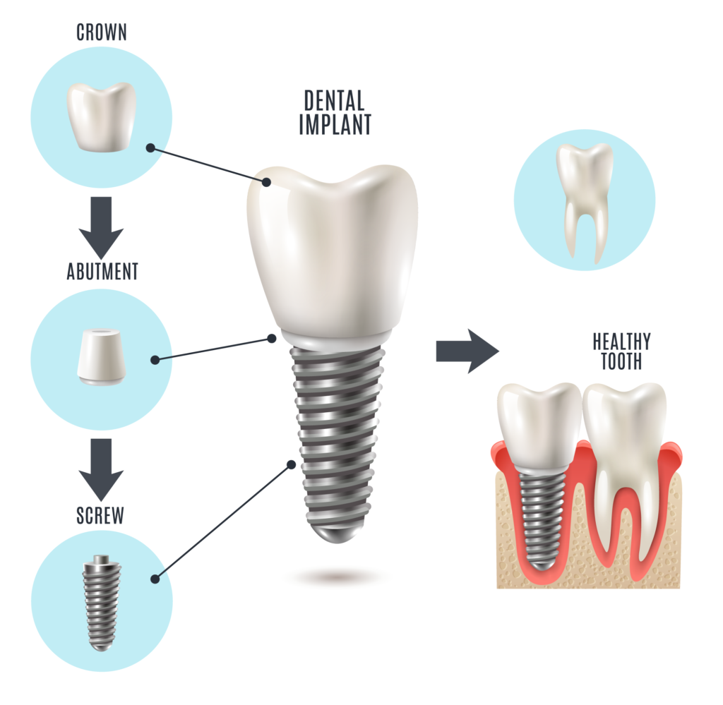 Can Teeth be Extracted and Implants Put in on The Same day