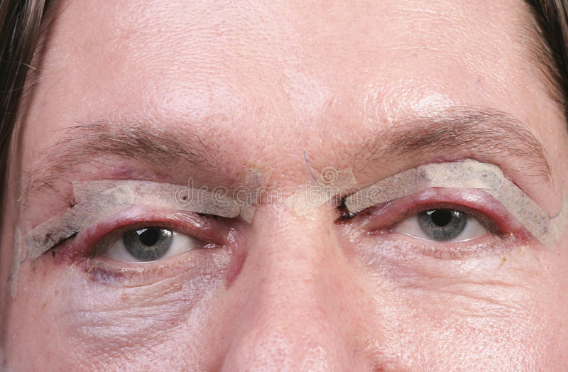 Can Upper Eyelid Surgery Go Wrong