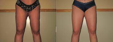 Can You Fix Botched Lipo