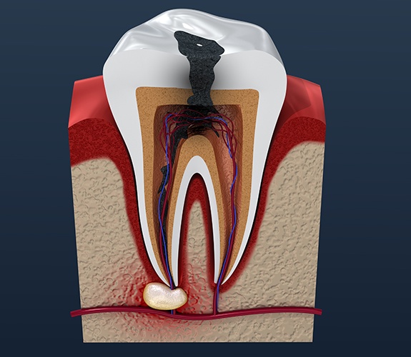 Can a Tooth Still Hurt After a Root Canal