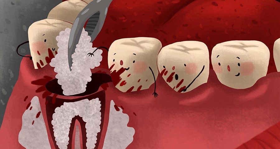 Dental Bone Graft Healing