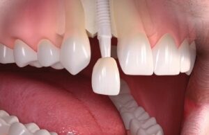 Dental Implant Front Tooth