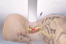 Do Epidural Steroid Injections Work For Sciatica