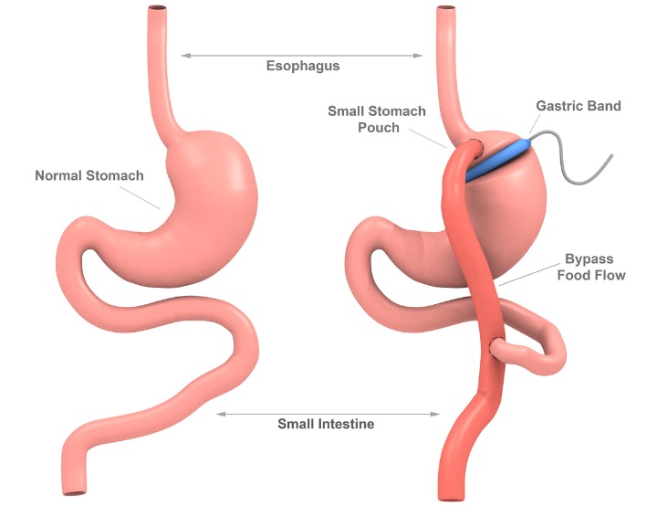 Does Gastric Bypass Shorten Life Span