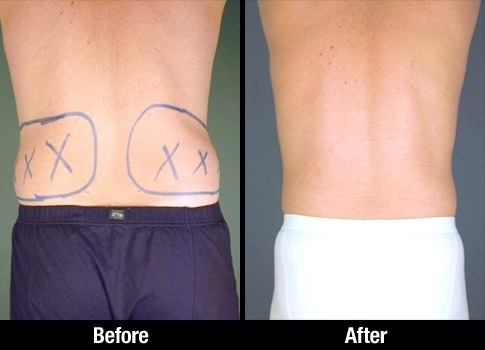 Flank Liposuction Before And After