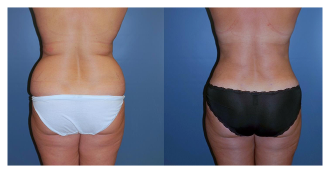 Flank liposuction before and after photos