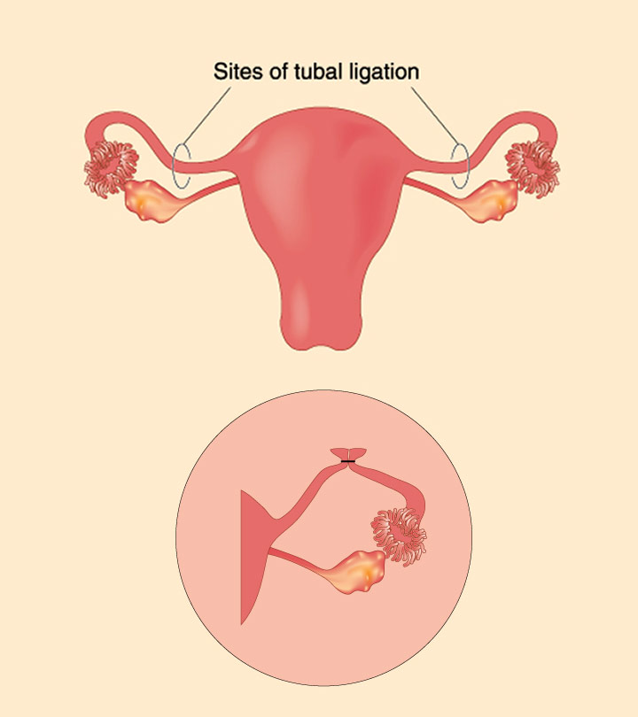 Has Anyone Had a Successful Pregnancy After Tubal Ligation